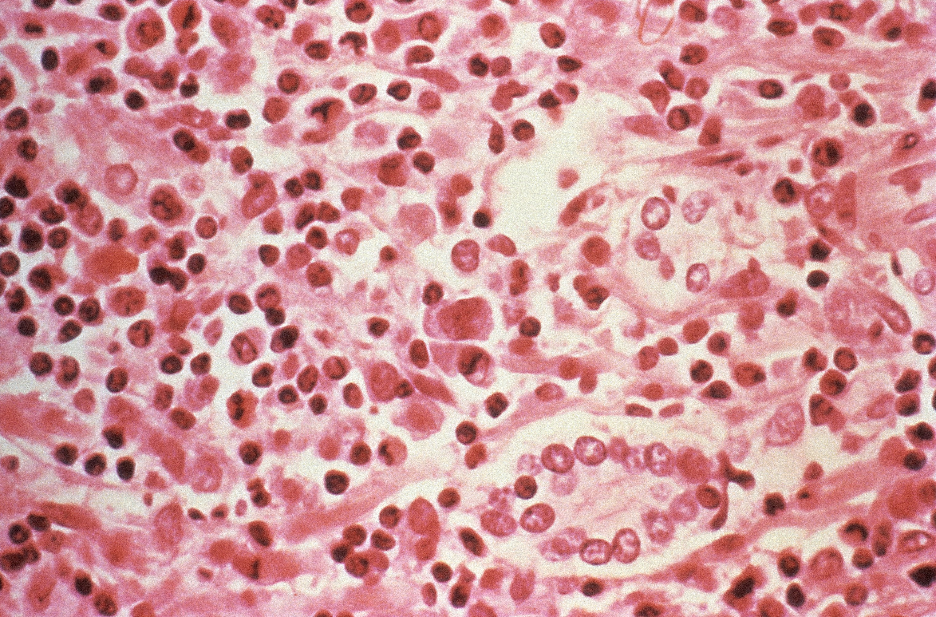 Understanding Fatty Liver Disease: Causes, Symptoms & Prevention